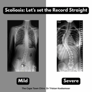 Scoliosis Chiropractor Cape Town