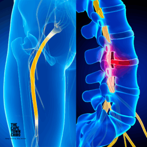 Can a Chiropractor fix a pinched nerve